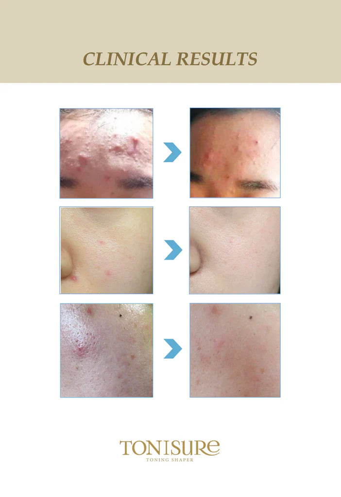 Tonisure- Plasma & Galvanic